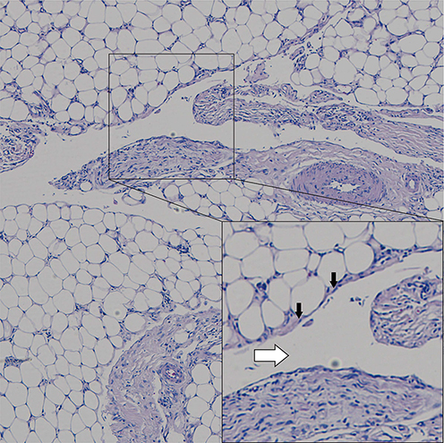 Figure 5 Pathological examination showing ectatic vascular spaces (white arrow) lined by flattened, cytologically bland endothelial cells (black arrow) dissecting through subcutaneous fat (Hematoxylin-eosin stain; original magnifications: B, × 4).
