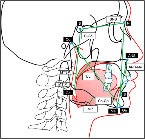 Figure 4 Sagittal and vertical dimension variables of the upper airway, soft tissue, and oral cavity in cephalometric images.