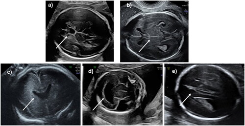 Figure 3. Pictorial essay showing different appearance of the cavum septi pelluci: normal in (a); obliterated in (b); agenesis of the CSP in (c); holoprosencephaly in (d); agenesis of the corpus callosum in (e).