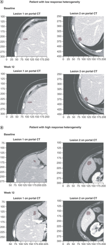 Figure 2. CT images of patients with lesions demonstrating high heterogeneity and low heterogeneity at baseline and week 12. (A) CT scans of lesions demonstrating low response heterogeneity at baseline and week 12. The response heterogeneity value, calculated as the SD of the LDr of the target lesions, was 0.01 for this patient. (B) CT scans of lesions demonstrating high response heterogeneity at baseline and week 12. The response heterogeneity value was 0.11 for this patient.CT: Computerized tomography; LDr: Longest diameter ratio; SD: Standard deviation.