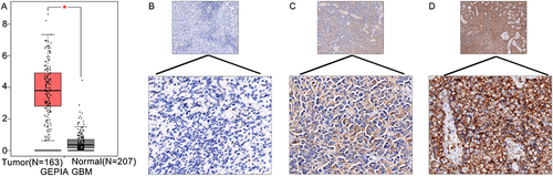 Figure 1 TREM-1 expression in GBM. (A) The mRNA expression of TREM-1 was significantly higher in GBM tissues compared to normal brain tissues. *p<0.05. (B-D) Representative immunohistochemical staining of TREM-1 in GBM tissues (upper panels, 100x magnification; lower panels, 400x magnification). (B) Weak, (C) moderate, and (D) intense immunostaining of TREM-1 in GBM tissues.