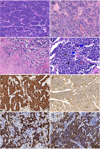 Figure 2 Histological morphology and immunohistochemistry of small cell neuroendocrine carcinoma of cervix. (A and B) Tumor cells are arranged in nests and trabeculae; abundant fibers and blood vessels are seen in the interstitium (100×, HE staining). (C) Tumor diathesis (100×, HE staining). (D) Tumor cells with scanty cytoplasm, typical nuclear molding (shown by black arrows), chromatin stippling, small nucleoli visible in a few tumor cells (shown by red arrows), nuclear mitosis easily visible (shown by blue arrows) (400×, HE staining). (E) Immunohistochemistry showing diffuse, positive P16 (200×). (F) Immunohistochemistry showing positive CD56 (200×). (G) Immunohistochemistry showing positive Syn (200×). (H) Immunohistochemistry showing positive CgA (200×).