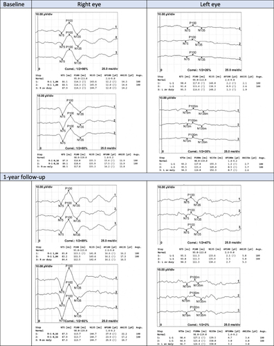 Figure 2 Evaluation of visual evoked potentials (PVEP) of a patient with myelin oligodendrocyte glycoprotein (MOG) antibody-associated optic neuritis in the left eye during 1-year follow-up.