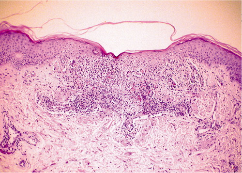 Figure 3. (b) Histological confirmation of moderate acute cellular rejection. Skin biopsy revealing perivascular and dermal lymphocyte infiltration, and mild degeneration of epidermis (hematoxylin and eosin, × 40).