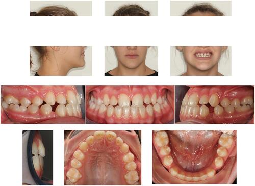 Figure 1 Patient initial facial and intraoral photos.