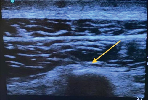 Figure 1. Ultrasound picture of ESPB.