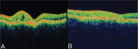 Figure 3 A) Oblique section of OCT of the LE revealing the characteristic appearance of outer and inner retina having similar reflectivity and an area temporal to the fovea with high reflectivity corresponding to the temporal area of choroidal neovascularization observed in the angiogram. B) OCT of the same section of LE revealing significant reduction in retinal thickness. The RPE remains thickened.Abbreviations: LE, left eye; OCT, optical coherence tomography; RPE, retinal pigment epithelium.