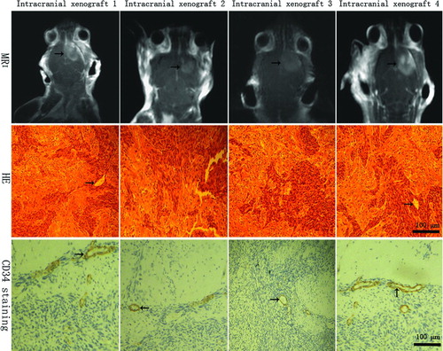 Figure 4  MRI and histopathologic features of intracranial xenografts. The 4 different intracranial xenografts generated from 4 corresponding flank GBM xenograft lines. MRI reveals irregularly and nonhomogeneously enhancing mass (black arrow) in contrast-enhanced T1-weighted imaging, which shared the similar MRI features with its corresponding human tumors. In HE-stained sections, the intracranial xenografts show mitotically active, high cellular density, poorly differentiated pleomorphic cells, necrotic foci, and some multinucleated cells, as well as mild or profuse microvessels (black arrow). Microvessels appear to consist of a continuous single layer of endothelial cells in CD34 immunostaining (black arrow), but endothelial proliferation is not observed compared with human tumors.