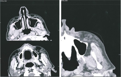 Figure 4 Axial T2 images with fat signal removed.