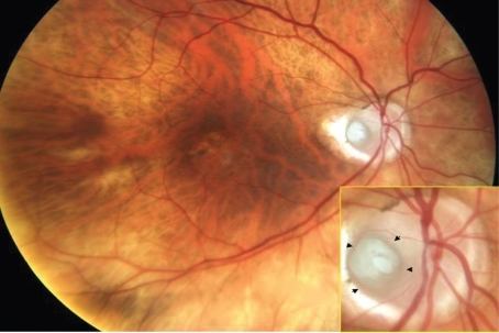 Figure 1 Color fundus photograph of the right eye, depicting an optic nerve pit with peripapillary atrophy. Mild pigmentary changes are present in the macula. Arrow heads point to the margins of the pit.