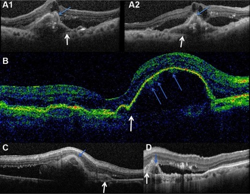 Figure 5 Four other eyes with spectral-domain optical coherence tomography showing atypical pigment epithelial detachments (PEDs) with polyps (blue arrows) adherent to the posterior surface of the elevated RPE line and anterior to Bruch membrane (white arrows).