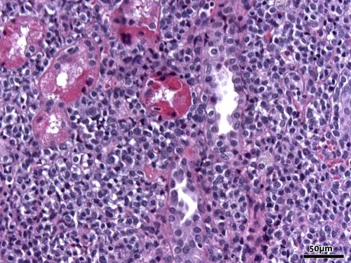 Figure 1. Massive infiltration of the interstitium of the kidney by blastic myeloid cells (hematoxylin and eosin, original magnification 20×).