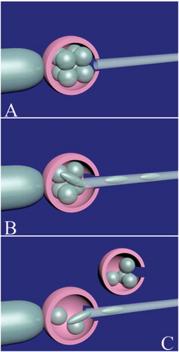 Figure 5. Embryo splitting technique in a cleavage-stage embryo. A good quality 8-cell embryo is selected for embryo splitting. The embryo is immobilized by the holding pipette. After opening the zona pellucida with a noncontact diode laser (A), half of the blastomeres are gently removed (B) and released to biopsy medium. An empty zona pellucida should be previously prepared from unfertilized/immature oocytes or clinically unsuitable embryos. The embryo is released from the holding pipette and the empty zona pellucida is held instead. The removed blastomeres are gently placed in the empty zona pellucida (C).