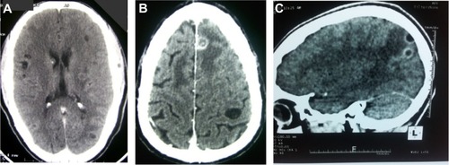 Figure 2 CT imaging of human neurocysticercosis.