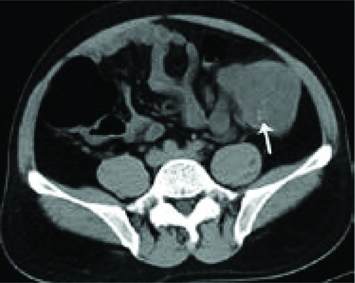Figure 8 Computed tomography scan of 44-year-old man with mucinous carcinoma in descending colon.