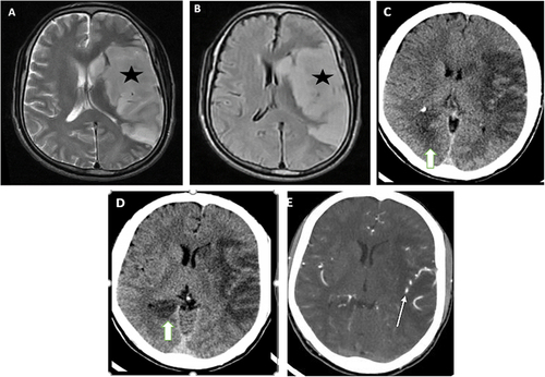 Figure 1 (A and B) There is diffuse swelling and T2/FLAIR hyperintensity of left insular cortex, head of caudate nucleus, lentiform nucleus, lateral parts of left frontoparietal lobes and superior part of left temporal lobe (asterisk in A and B). They have marked restricted diffusion (not displayed here), which is indicative of left MCA cortical and lenticulostriatal territory acute infarction. (C and D) pre- and post-contrast CT studies done 8 days after the MRI was taken. Diffuse low attenuation is observed and a new focus of hypodensity is noted involving the medial part of occipitotemporal lobe (thick arrow in C and D) suggestive of right PCA territory acute infarction. (E) The middle cerebral artery segments and its branches showed normal caliber, smooth wall, and patent lumen (thin arrow in E).