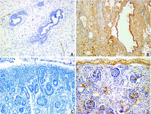 FIGURE 2  TGF-β staining. (A) Negative in obstructive MCDK. (B) Positive staining in interstitium and tubular epithelium of nonobstructive (syndromic) MCDK. (C) Negative staining in tubules including nephrogenic zone of fetus. (D) Focal staining in glomeruli of controls. 76 × 57 mm.