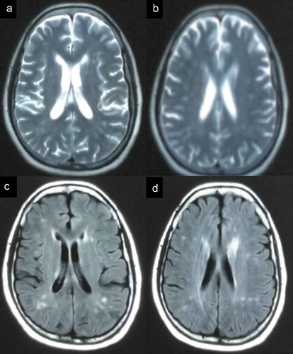 Figure 5. The imaging of the patient. MRI showed abnormal signals in the bilateral frontal subcortical areas and the periventricular area of the lateral ventricles.