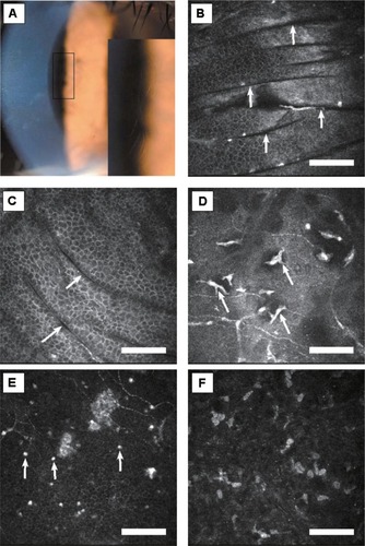 Figure 2 Case 2. (A) Slit-lamp photograph of right cornea. Fingerprint-shaped abnormalities in the central cornea are magnified in the lower right box. (B and C) In vivo laser confocal microscopic images of corneal lesions. Multiple dark parallel striae in the superficial/basal epithelium and Bowman’s membrane layer (arrows, depth 22 μm and 25 μm, respectively). (D) Infiltration of possible Langerhans cells in Bowman’s membrane cell layer (depth 51 μm, arrows). (E) Highly reflective dots were observed in the basal epithelial layer (depth 60 μm, arrows). (F) Highly reflective microdots were observed in the stroma (depth 80 μm).