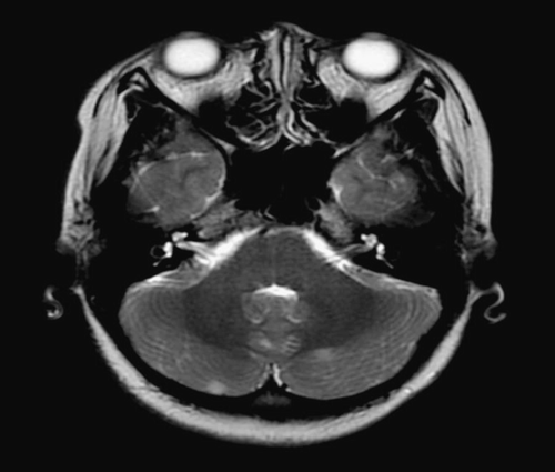 Figure 1.  MRI showing T2 hyperintensities in bilateral cerebellar hemispheres in Patient 2