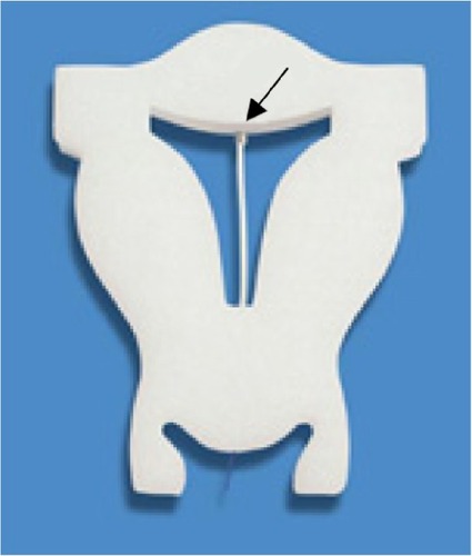 Figure 1 FibroPlant® LNG-IUS releasing 14 µg or 20 µg of LNG/day has a diameter of 1.2 mm and 1.6 mm, respectively. The stainless steel clip securing the fiber to the anchoring thread is shown (arrow).