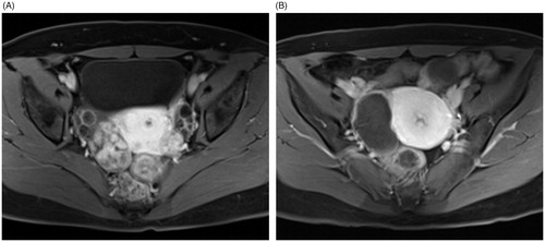 Figure 1. Contrast enhanced-MRI images of a 36-year-old woman with a right broad ligament fibroid. These showed a moderately vascular fibroid before treatment (A) and more than 90% NPV ratio immediately after HIFU ablation (B).
