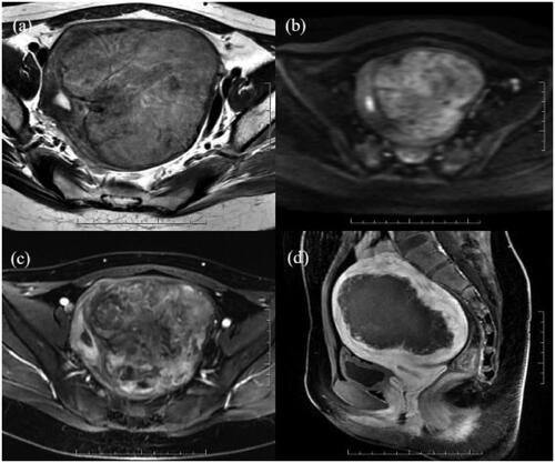 Figure 5. A 21-year-old patient with a uterine fibroid in the left wall of the uterus. The uterine fibroid showed high signal intensity on T2WI (a) and DWI (b) and significant enhancement on CE-MRI (c) before HIFU, and all of the values were 2. The values of wavelet_HHH_firstorder_Skewness and wavelet_HHL_glszm_sizezonenonuniformity were 0.02 and 2.14, respectively. CE-MRI after HIFU showed that the ablation area was not enhanced (d). The predicted and actual NPVR values were 69% and 66%, respectively.