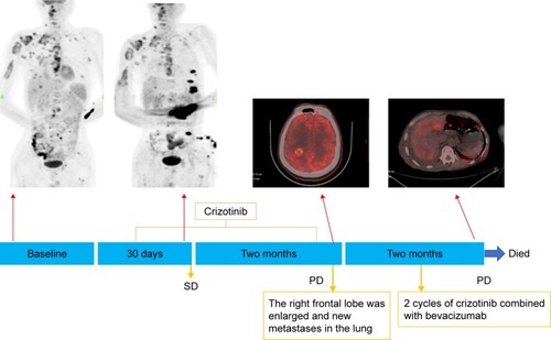 Figure 4 The clinical course of the diagnosis and treatment of the patient. On August 11, 2015, the PET-CT scan of the patient suggested right upper chest, brain, bone, liver, and right subscapularis muscle metastases. Methylprednisolone was given at 800 mg/d, d1-5, started on August 20, 2015. On September 10, 2015, PET-CT imaging showed tumor volume enlargement, and crizotinib was given at 250 mg daily. On October 9, 2015 (after one month of crizotinib treatment), PET-CT imaging showed a dramatic reduction in tumor size and metabolism, resulting in SD. (The concentrations in the left elbow and chest wall were radiocontamination.) On December 7, 2015, the brain imaging PET-CT showed that the primary tumor was enlarged, representing progressive disease in the brain, and bevacizumab (500 mg/d, d1, every 21 days), combined with crizotinib at 250 mg daily, was administered. On February 2, 2016 (after two cycles of bevacizumab with crizotinib), PET-CT imaging showed right pleural effusion, all body metastases were enlarged, and pleural cavity and peritoneal effusions could be found. Then, nutritional supportive treatment was given. The patient died in March 2016.