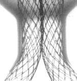 Figure 5. X-rays of the device deployed in the mock aneurysmal glass were very instructive of the construction of the AneuRx stent-graft.
