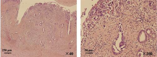 Figure 1 Representative postoperative pathological images of gallbladder mass (hematoxylin and eosin stain).