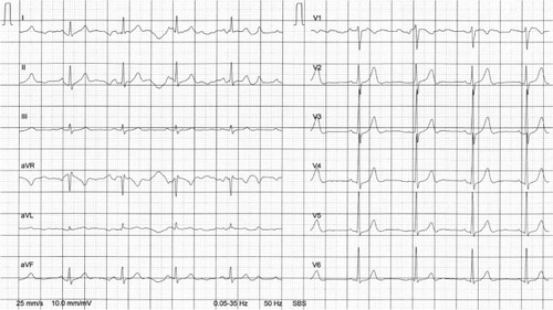 Figure 3 ECG at rest from brother B.