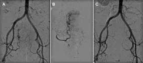 Figure 4 Uterine fibroid treatment.