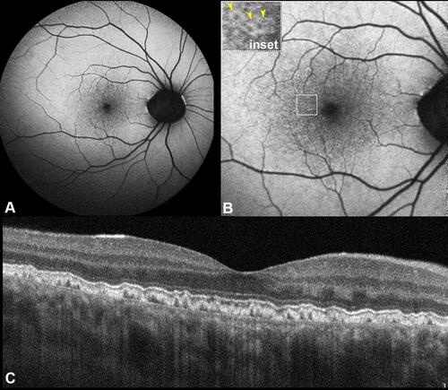 Figure 1 Short wavelength fundus autofluorescence (FAF). (A) A 55-degree FAF acquired using a Spectralis (Heidelberg Engineering, Heidelberg, Germany) device that uses a 488 nm illumination wavelength and emission detection between 500 and 700 nm; FAF imaging demonstrated pinpoint hypoautofluorescent alterations confined within the posterior pole. (B) A 35-degree FAF magnification shows more easily the typical pattern of cuticular drusen constituted by central hypofluorescence surrounded by a hyperautofluorescent halo (yellow arrowheads, inset). (C) Subfoveal optical coherence tomography B-scan demonstrating multiple retinal pigment epithelium-basal lamina elevations with a classical saw tooth configuration.