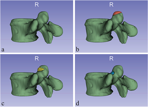 Figure 3 (a) 3D model of the superior articular process of model before foraminal molding. (b) 3D model of intervertebral foramen molding at the tip of the superior articular process, with the resected tip bone in red. (c) 3D model of intervertebral foramen molding on the ventral side of the superior articular process, with the resected ventral bone in yellow. (d) 3D model of intervertebral foramina molded into the base of the superior articular process, with the resected basal bone in blue.