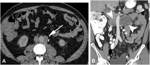 Figure 5 Retroperitoneal metastasis. (A) Left para-aortic lymph node on a patient with left-sided testicular mass. (B) Bilateral large heterogeneous retroperitoneal lymph nodes.