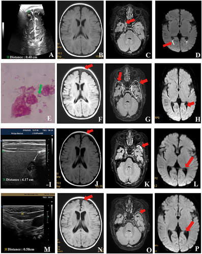 Figure 1 The laboratory, imaging, and pathology examination results related to the Prevotella bivia meningitis. The green arrow indicates the strain seen under the microscope of the CSF specimen, and the red arrows indicate the location of the imaging changes. (A) Ultrasonography revealed 0.4cm anechoic area in the subarachnoid space (Day 0). (B) T2-fluid attenuated inversion recovery (T2-FLAIR), no subdural effusion (Day 1). (C) T2-FLAIR revealed enhancement and linear hyperintensity in the right middle cranial fossa, indicating mild meningitis (Day 1). (D) Diffusion-weighted imaging (DWI) showed diffusion limitation of the posterior horn of bilateral ventricles, suggesting ependymitis and empyema (Day 1). (E) Microscope examination showed a small number of gram-negative bacilli (Day 1). (F) T2-FLAIR displayed slightly higher signal intensity in the lower stripe of the left frontal cranial plate (Day 13).(G) T2-FLAIR exhibited enhancement in the subdural effusion and linear high signal intensity in the bilateral middle cranial fossa, suggesting increased severity of meningitis compared to previous findings (Day 13). (H) DWI showed the disappearance of high signal in the posterior horn of bilateral ventricles, indicating the improvement of empyema (Day 13). (I) Liver volume increased by 4.17cm (Day 6). (J) T2-FLAIR revealed decreased subdural effusion in the left forehead and at the midline of the right subcostal clavicle (Day 31). (K) Enhanced T2-FLAIR indicated improved meningitis compared to the earlier result (Day 31). (L) DWI showed normal findings in the posterior horn of bilateral ventricles (Day 31). (M) Bilateral sternocleidomastoid muscle scan indicated a thickness of approximately 0.60cm for the right muscle and 0.58cm for the left muscle (Day 27). (N) T2-FLAIR demonstrated significantly reduced left subdural effusion compared to the previous result, indicating basic absorption (Day 31), with further improvement on Day 69. (O) Enhanced T2-FLAIR indicated improved meningitis (Day 69). (P) No abnormalities were observed in the posterior horn of bilateral ventricles (Day 69).