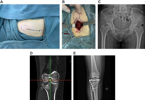 Figure 2 (A–E) depicts a 53-year-old female patient who was administered general anesthesia before undergoing open reduction, internal fixation, and bone grafting to treat her right tibial plateau fracture. During surgery, tricortical iliac bone harvesting was used. (A) illustrates the location of the bone-harvesting site before surgery. (B) displays the bones being harvested. (C) shows a postoperative image of the pelvis. (D) presents a clear right tibial plateau fracture and articular surface collapse. (E) is a postoperative image of the tibial plateau fracture.