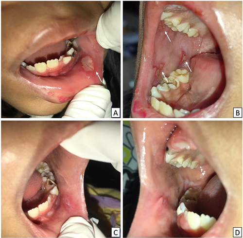Figure 3 Intraoral conditions in patient Case 3 (A and B) On the first visit, there were several yellowish ulcers on the right buccal mucosa accompanied by a single yellowish ulcer on the left buccal mucosa (C–D) The improvement condition was observed after 7 days.