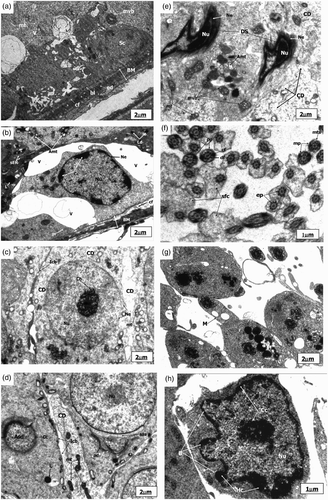 Figure 3.  Electronmicrograph of zinc deficient groups after 4 weeks showing several apoptotic features. The scale bar = 2 µm (A, B, C, D, E, and G); The scale bar = 1 µm (F and H). (A) Electronmicrograph of testes of 4ZD group showing basement membrane (BM) with layer of basal lamina (bl), collagen fibers (cf) and cytoplasmic extensions of endothelial cells (ed). Degenerative changes are evident in the Sertoli cell (Sc) cytoplasm. Multivesicular bodies (mvb), vacuolization (v), and few mitochondria (mt) are distinct. (B) Electronmicrograph of 4ZD group testes showing disrupted spermatogenic epithelium (BM), dissolution of collagen fibres (cf) and displaced Type B spermatogonium nucleus (Nu) with condensed chromatin (Cc) associated with the nuclear envelope (Ne). Cytoplasm reveals vacuolization (V) with complete loss of junctional complexes. Lysosomes (Ly), deformed mitochondria (Amt), polyribosomes (pr), smooth endoplasmic reticulum (sER), and lipid droplets (Ld) are evident. (C) Ultrastructure of 4ZD group testes displaying primary spermatocyte nucleus (Nu) showing dissolution of nuclear envelope (Ne) and chromatin conglomerates (Ch). Cytoplasm reveals ovoid mitochondria (mt) and interrupted intercellular bridges (Icb). Cytoplasmic dissolution (CD) is also evident in some areas. (D) Electronmicrograph of testes of 4ZD group displaying detachment of acrosomal cap (ac) from head region of spermatid nucleus (Nu) just above the sub-acrosomal space (sas). One of the apoptotic spermatid (Asd) showing ring of condensed chromatin (Cc) around the nuclear periphery. Presence of mitochondria (mt) and lysosomes (Ly) are distinct. Degeneration of cytoplasm (CD) between the two spermatids is evident. (E) Electronmicrograph of testes of 4ZD group revealing deformed sperm heads (DS) with condensed nucleus (Nu), and disintegrated nuclear envelope (Ne). Cytoplasm shows few deformed mitochondria (Amt), multivesicular bodies (mvb), and dissolution of cytoplasm (CD) in some areas. (F) Cross sectional view of mid-piece (mp), principal piece (pp), and end piece (ep) of 4ZD spermatozoa tail revealing outer dense fibres (df) and central fibres (cf), mitochondrial sheath degeneration (mts) and retention of superfluous cytoplasm (sfc). (G) Aggregation of spermatozoa enclosed by a cytoplasm and common membrane (M). (H) Electronmicrograph of testes of 4ZD group displaying late apoptotic stage of Leydig cell nucleus (Nu) in which both chromatin (Cc) and cytoplasm have condensed. Peripheral heterochromatin (Hc) is distinct. Blebs (B) in the nuclear membrane of Leydig cell is also evident.