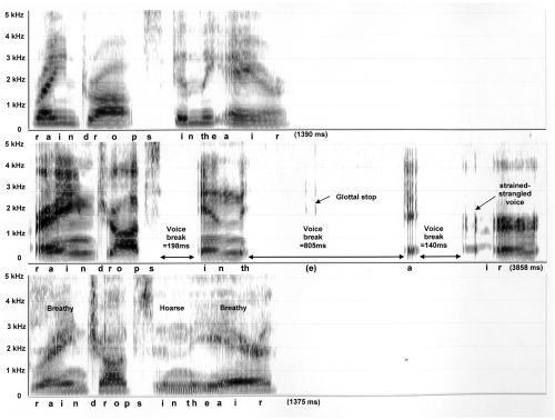 Figure 1 Spectrograms of the phrase “… raindrops in the air …” spoken by a 38 year old female: normal control subject is depicted on the top panel, ADSD before BT injection is on the middle, and ADSD after BT injection is on the bottom panel.
