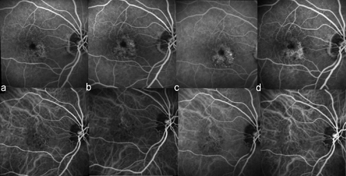 Figure 1 Fluorescein angiography (FAG) and indocyanine green angiography (ICGA) from an 82-year-old female patient after loss of visual acuity (VA) in her right eye (RE) and who received 5 injections of intravitreal (ITV) pegaptanib sodium.a. pre-injection; b. post second injection; c. post third injection; d. 9 months post fifth injection.