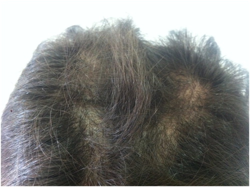 Figure 1. Vertex with broken hairs (with no vellus) as thought they had been cut with scissors or a razor.