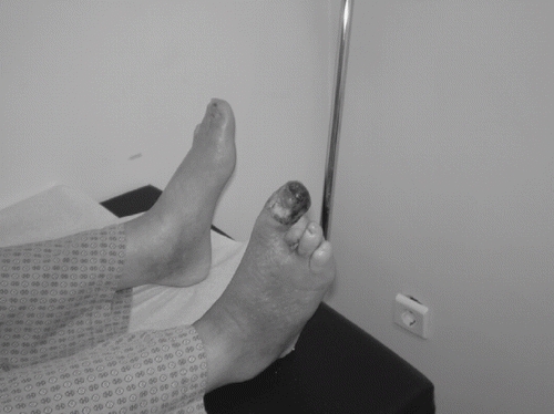 Figure 1. Gangrene of the right hallux in a patient with longstanding diabetes, peripheral arterial disease, and ESRD. The second and third toes have been amputated previously. Deep culture after drainage of the pus in the proximal phalanx of the hallux grew Enterococcus faecalis and Pseudomonas aeruginosa.