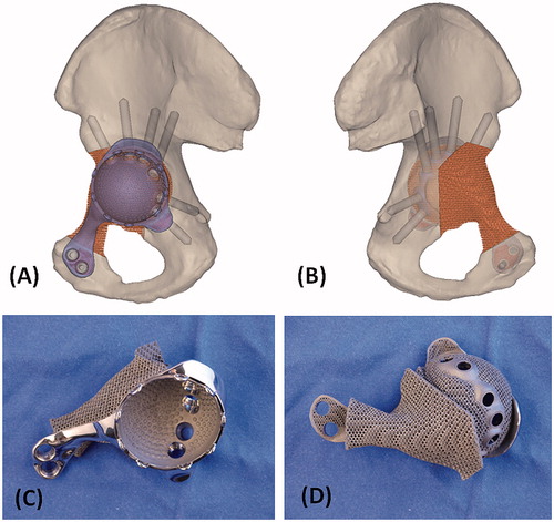 Figure 3. The 3D pelvic model (A: lateral view; B: medial view) showed the implant reconstruction and screws fixation. Screw positions and lengths were planned, based on the bone thickness and quality of the remaining bone after resection. The implant design and the reconstruction were then subjected to FEA evaluation. After the surgeons approved the implant design, the implant was 3D printed as a titanium monoblock. (C) The outer view of the implant showed the solid plate, flanges and the acetabular cup with screws holes for fixation. (D) The back side of the implant showed the porous scaffold that was in contact to the host bone. The scaffold has an interconnected network of pores with an average porosity of 70%. The pores have an average size of 720°μm and the thickness of the solid struts is around 350°μm. This allows the bone to grow inside the construct to achieve a stable biological fixation. The porous construct is also highly resistant to mechanical compression, while its elastic modulus is comparable to that of bone to minimize the risk of the peri-implant stress shielding.