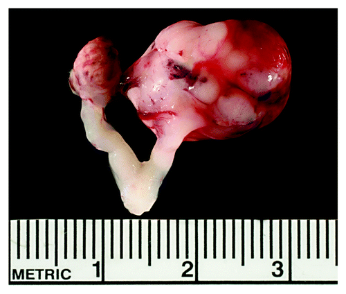 Figure 1. Bilateral GC tumor specimen. Spontaneous GC tumors in SWR-derived mice are easily recognized as large, 5–15 mm cystic or solid masses with blood filled spaces when compared with a normal ovary of 2–3 mm. This image shows a representative bilateral GC tumor specimen with the uterus still attached. The specimen was isolated from an 8 wk old SWR.SJL-X3 congenic female that carries the Gct4J modifier allele. The GC tumor on the left is less vascularized and more necrotic than the larger, highly vascularized tumor on the right.