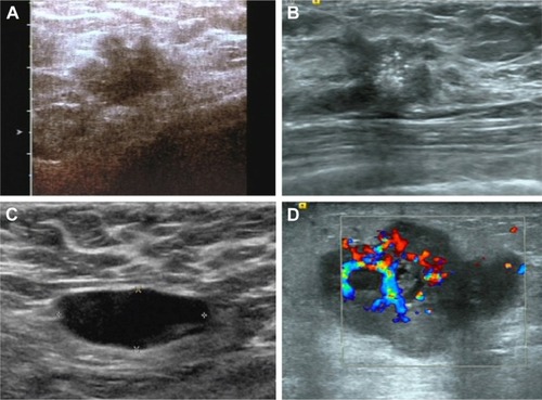 Figure 1 Ultrasonographic features of the patients with breast cancer.