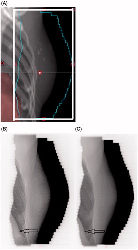 Figure 2. The error in distance of the heart surface inside the tangential treatment field was retrospectively analyzed from the tangential images. A) tangential image of the planning CT. B) and C) daily tangential images of the same patient in treatment position before and after the BHL correction, respectively. The heart surface is pointed by arrows.