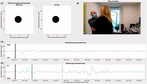 Figure 4. The initial frame of a video showing the eye-movements of a patient undergoing a Dix-Hallpike manourvre. (a) and (b) show the horizontal and vertical eye movement traces as captured by the CAVA® device. The black line marks the current timestamp, and event marker activations are shown as orange lines. (c) Shows an animated reconstruction of the patient’s eye movements in 2D. The video in (d) shows the clinician activating the device’s event marker, performing the Dix-Hallpike manourvre on the patient, followed by a closeup of the patient’s eyes. The first event marker activation allowed the eye-movement channels to be aligned temporally with the video of the patient undergoing to the procedure. The second activation was at the first sign of nystagmus, which coincided with the patient reporting the onset of vertigo, and the final event mark was deployed after the nystagmus had ceased. The green line in (b) is the point at which the video in (d) is rotated by 180 degrees, so that they are presented in the same orientation.
