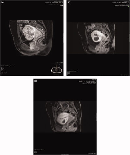 Figure 3. MRI images of a patient with two uterine fibroids. (a) before MWA, (b) 6 months after MWA and (c) at 19 months (sagittal view). At 19 months one fibroid is no longer visible.