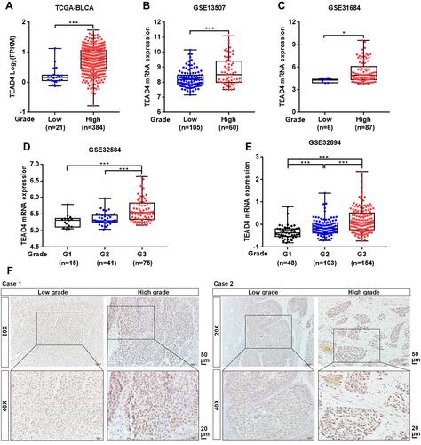 Figure 3 TEAD4 expression is increased in high-grade patients with UBC. (A–E) TEAD4 mRNA expression level in different tumor grade phase of UBC samples from TCGA-BLCA (A), GSE13507 (B), GSE31684 (C), GSE32584 (D), and GSE32894 (E) datasets. (F) Representative IHC staining images of the TEAD4 expression in low grade and high grade of UBC patients were displayed. Scale bar, 50 and 20μm. *P<0.05, ***P<0.001.